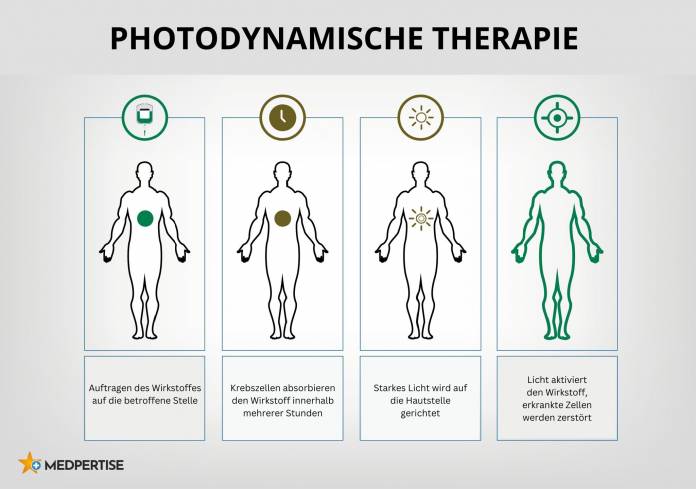 Ablauf einer Photodynamischen Therapie