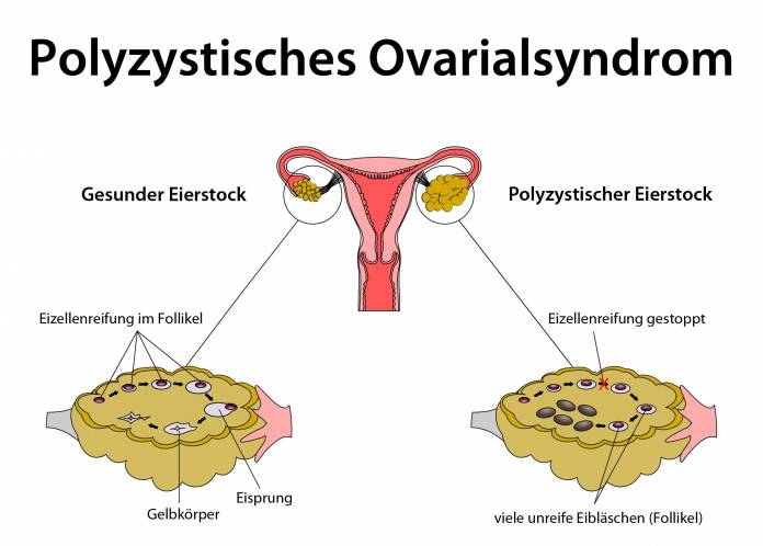 Polyzystisches Ovarialsyndrom
