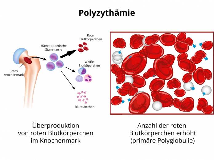 Polyzythämie (Polycythemia vera)