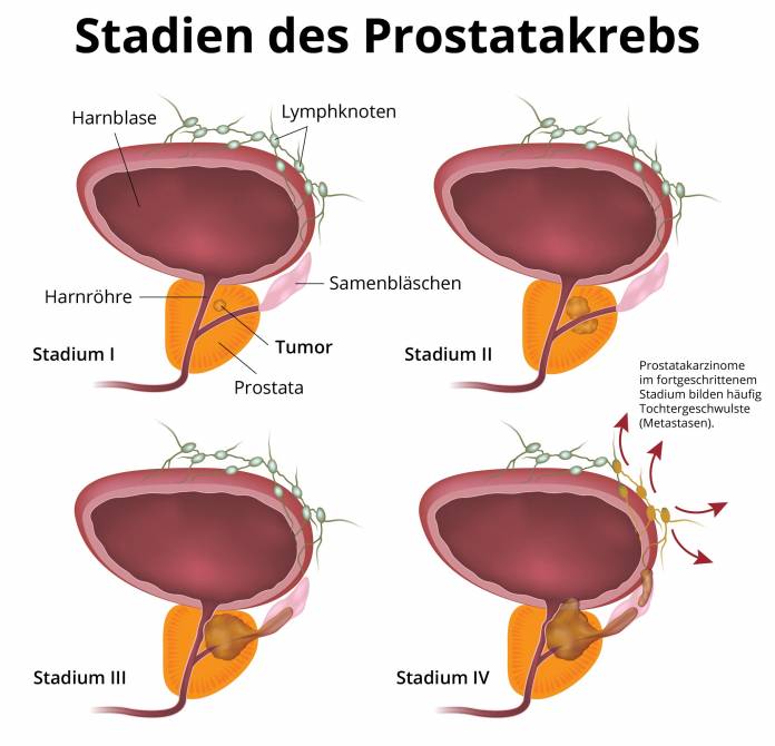 Stadien des Prostatakrebs