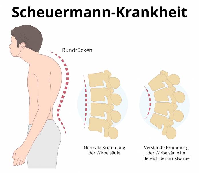 Scheuermann-Krankheit