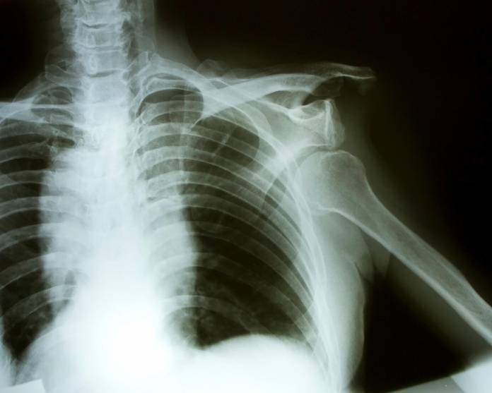 Röntgenaufnahme einer Schulterluxation