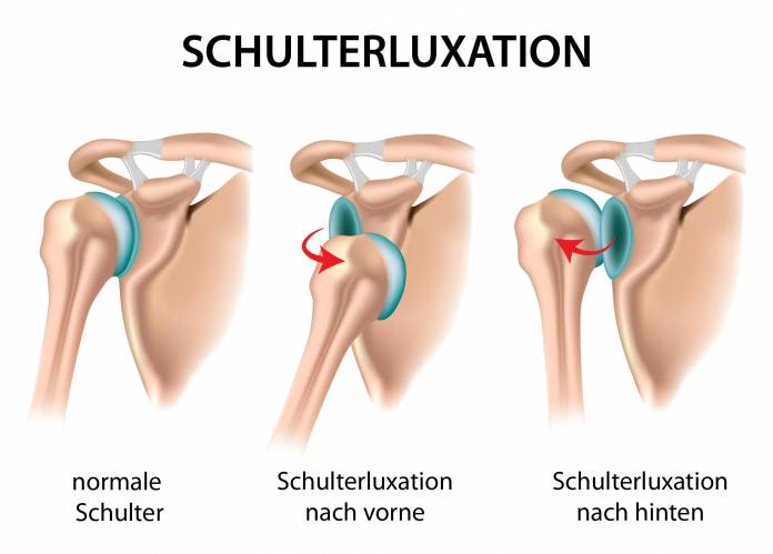 Schulterluxation