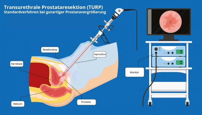 Transurethrale Prostataresektion (TURP)