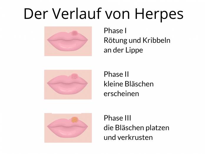 Verlauf von Herpes